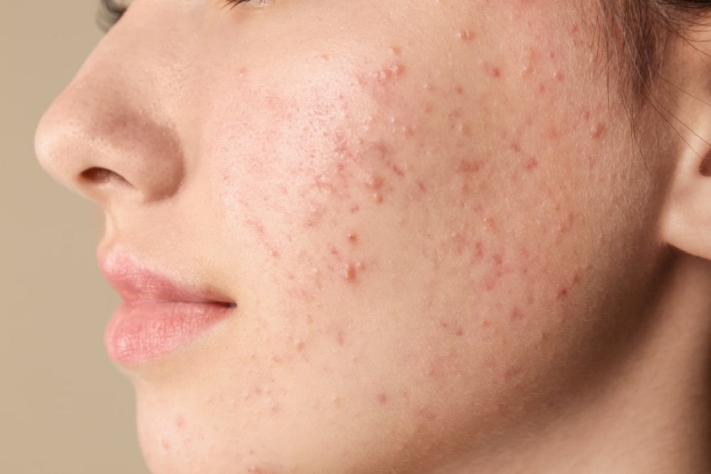 Tips to Take Care of Acne Prone Skin
